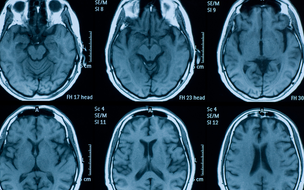 Demência deverá afetar 139 milhões de pessoas em 2050, diz OMS