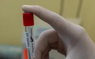 No Brasil, casos de Covid-19 triplicam em apenas uma semana