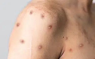 Sobe para 34 o número de casos confirmados de Varíola dos Macacos no Piauí