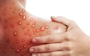 Brasil recebe insumos para produção de vacina contra a Varíola dos Macacos