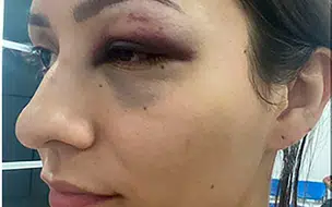 TJ PI anuncia exoneração de servidor que agrediu namorada em Teresina