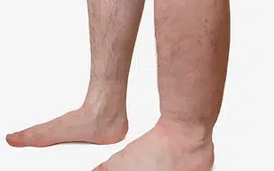 Elefantíase no Brasil não é mais considerado problema de saúde pública; Entenda