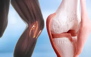 Recuperação de Neymar: Especialista Detalha Processo de Lesão