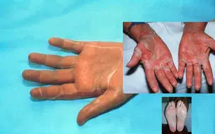 Japão enfrenta aumento de casos de Síndrome do Choque Tóxico Estreptocócico