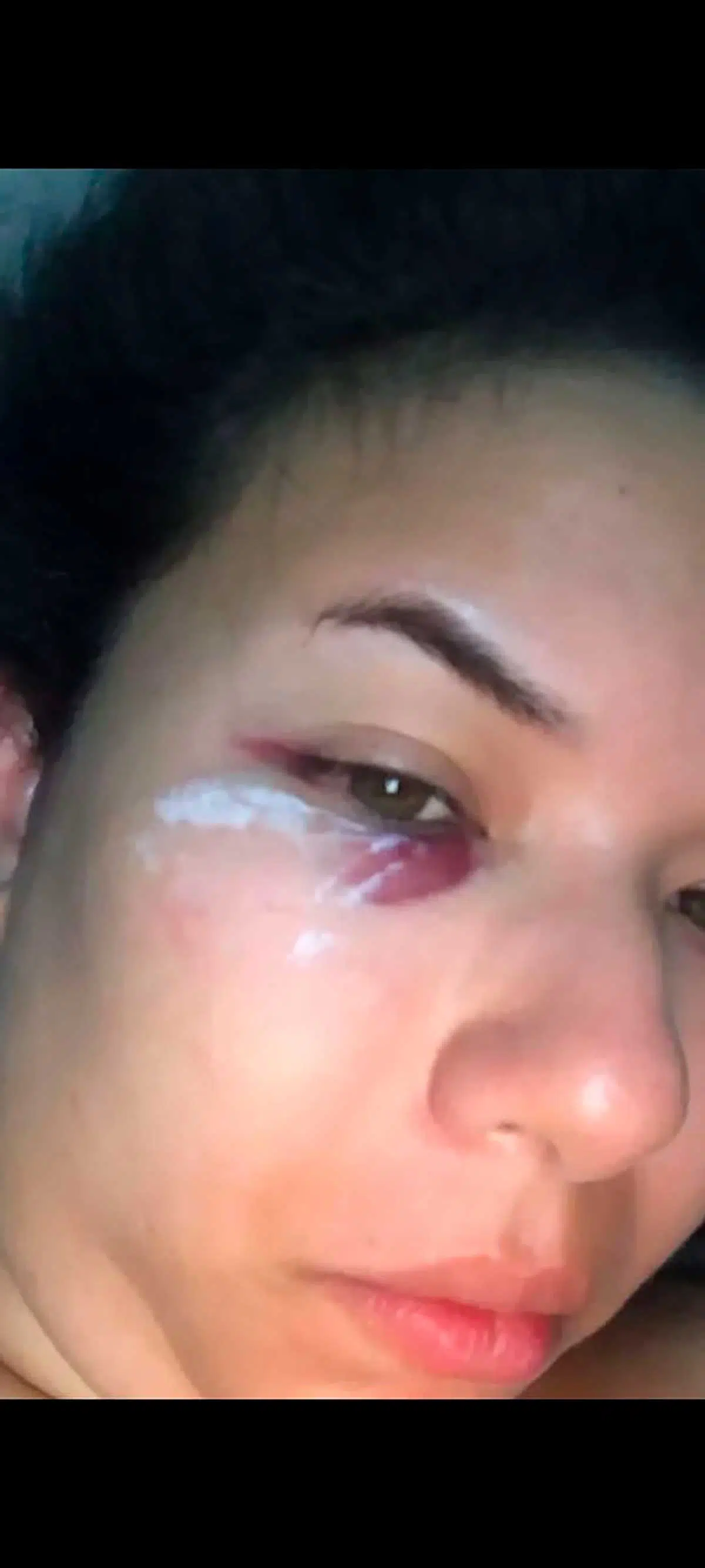 Yara Ataíde com um hematoma no rosto após ter sido agredida pelo ex-marido