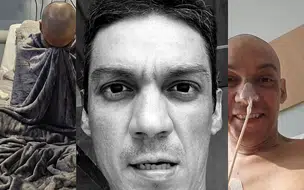 Prefeito Bruno Neto compartilha emocionante relato sobre sua luta contra a leucemia