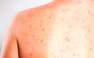 Distrito Federal registra primeiro caso de sarampo em cinco anos