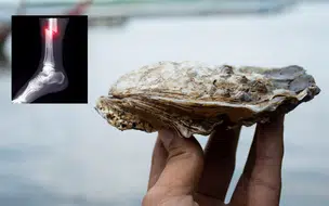 Cientistas chineses criam “cola óssea” que pode substituir placas e parafusos em fraturas