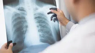 Anvisa aprova novo medicamento para câncer de pulmão avançado