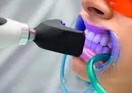 Clareamento dental gratuito em Teresina; Saiba como conseguir atendimento