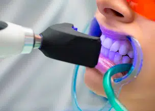 Clareamento dental gratuito em Teresina; Saiba como conseguir atendimento