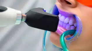 Clareamento dental gratuito em Teresina; Saiba como conseguir atendimento