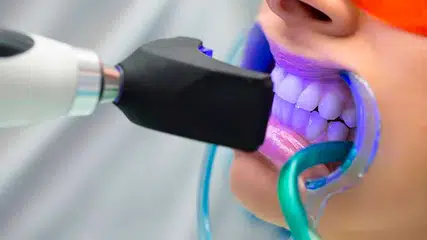 Clareamento dental gratuito em Teresina; Saiba como conseguir atendimento
