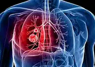 FMS alerta sobre sintomas da tuberculose e faz busca ativa de casos