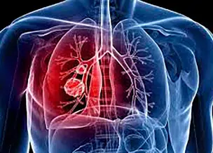 FMS alerta sobre sintomas da tuberculose e faz busca ativa de casos
