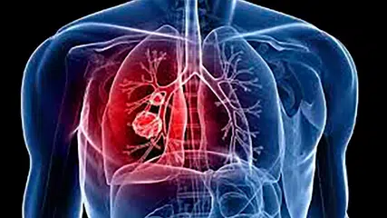 FMS alerta sobre sintomas da tuberculose e faz busca ativa de casos
