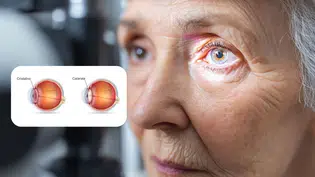 Prefeitura de Coivaras abre agendamentos para cirurgias de catarata