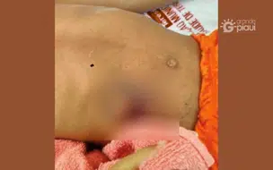 Criança de 4 anos é baleada durante brincadeira com arma caseira em Nazária