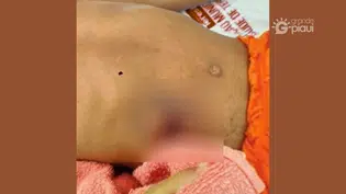 Criança de 4 anos é baleada durante brincadeira com arma caseira em Nazária