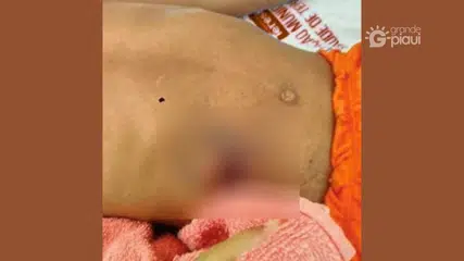 Criança de 4 anos é baleada durante brincadeira com arma caseira em Nazária