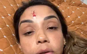 Cantora denuncia ex por agressão e aparece com rosto sangrando nas redes sociais