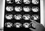 Anvisa aprova novo medicamento para câncer colorretal metastático