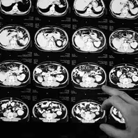 Anvisa aprova novo medicamento para câncer colorretal metastático