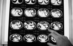 Anvisa aprova novo medicamento para câncer colorretal metastático