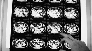 Anvisa aprova novo medicamento para câncer colorretal metastático