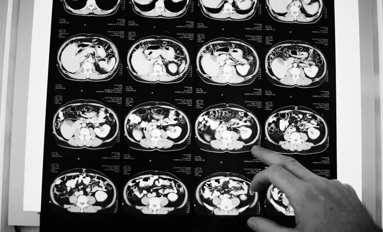 Anvisa aprova novo medicamento para câncer colorretal metastático