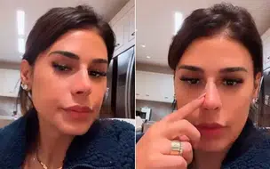 Nariz de Simone Mendes repercute na internet e cantora nega intervenção cirúrgica